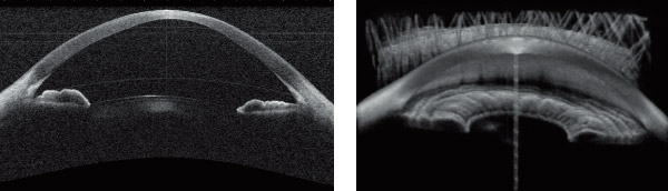 Cornea / Anterior Segment OCT CASIA2